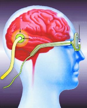 义眼植入手术如何运作 带你看人工视觉系统助