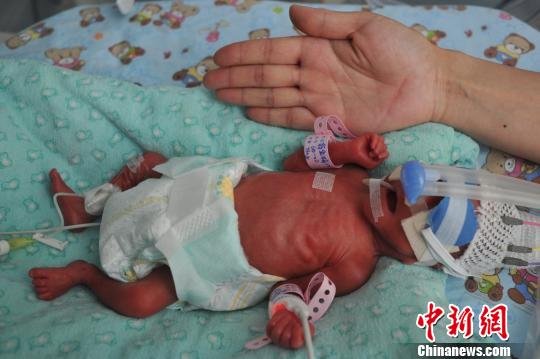 陕西早产袖珍婴儿重量仅相当于一瓶矿泉水(图