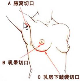 紫馨韩国姜炼雄院长谈隆胸人群选择切口的差异