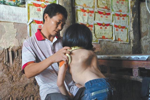 四川达州女孩身患重疾 脊椎畸形似漏斗(图)