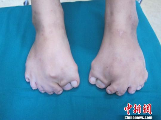 <em>奇怪</em>:<em>女孩</em>患罕见病双脚15根脚趾_社会新闻_南