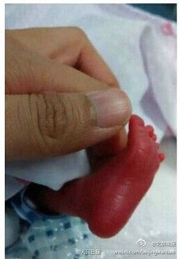 24周大"巴掌婴儿"出院 为国内胎龄最低婴儿