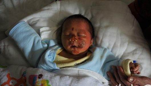 出生6天女婴医院洗澡时被烫伤 疑助产士未试水