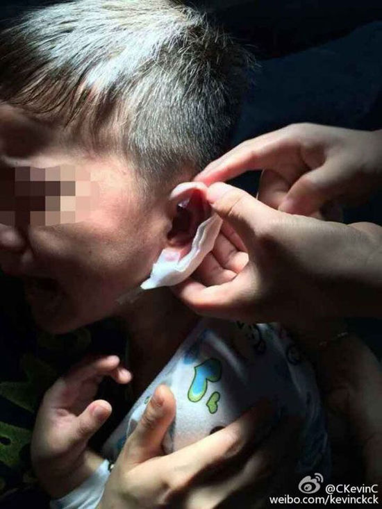 4岁幼童耳朵被幼儿园教师用钉钉穿 当地教育部