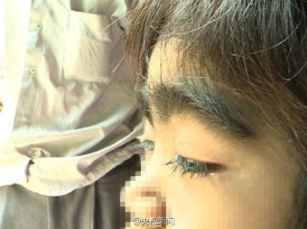广西<em>8岁女孩</em>全身长满黑毛 做梦都想脱毛(图)▏