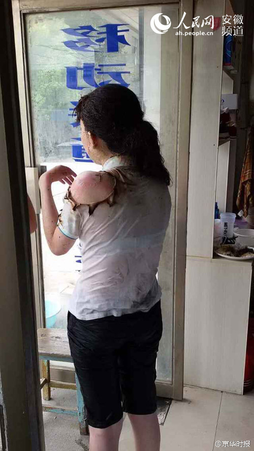 女生被<em>酒精</em>烧伤:<em>头发</em>被点燃,左耳到下巴受损(组