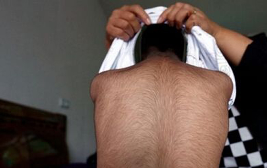  男童长满黑毛 成 小毛孩 先天性疾病难治愈(图)