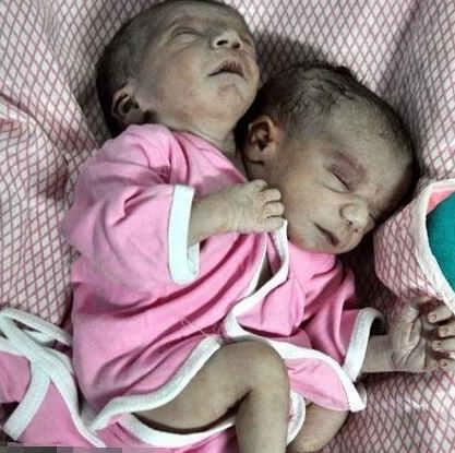  印度女产双头宝宝 (组图)为何会出现双头宝宝呢