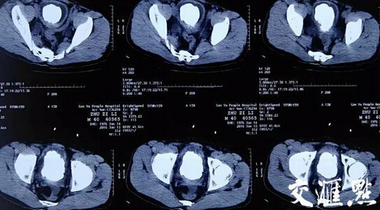  膀胱取出2斤结石  忍痛十年医生首遇(组图)▏医