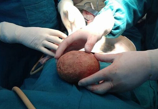  膀胱取出2斤结石 (组图)女子眼睛挖出石头 究竟