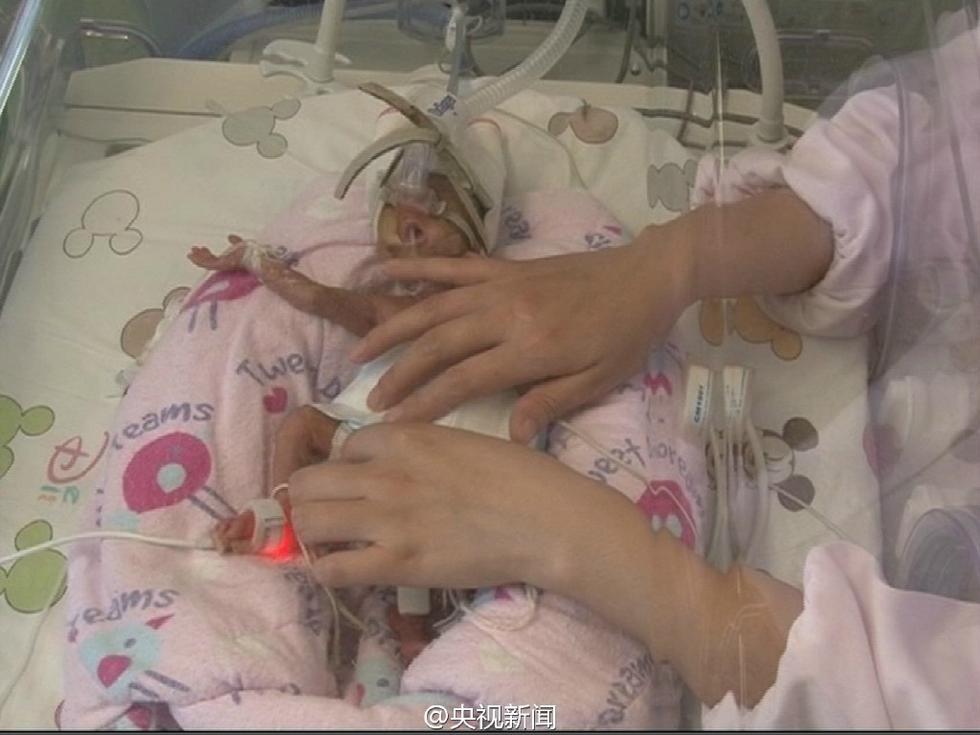 六个月大早产女婴仅有630克 胳膊如成人手指