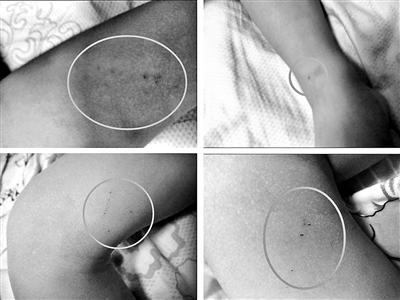调查：三岁男童疑被老师针扎10处 大腿内侧被扎成马蜂窝了