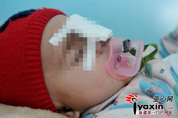 女童不慎摇篮跌下扎伤眼球(图)眼睛流血化脓或