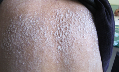  男子患病如沙人  一动就全身掉皮屑(图)▏沙人 