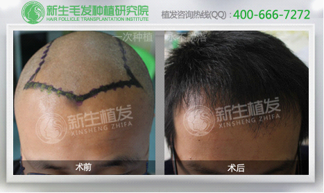 植发可否改善<em>头发</em>少的情况? 佛山健康资讯 南