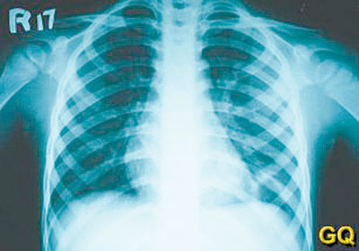 肺部听诊较少阳性体征;x线胸片主要表现为