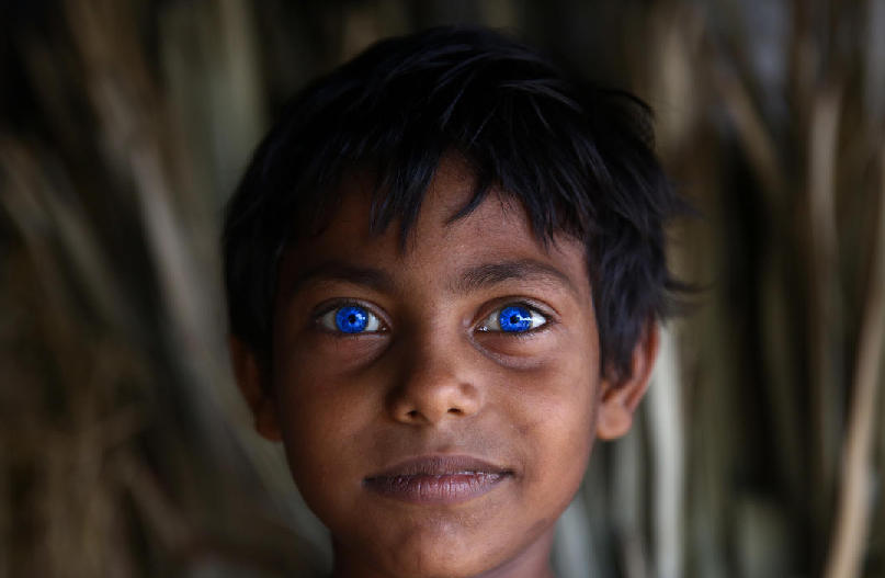 孟加拉男孩长有如同"异鬼"一样蓝色瞳孔