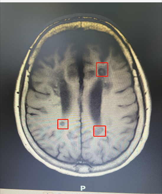 何阿姨脑部磁共振检查图，标识部分为脑囊虫头节。广医二院供图