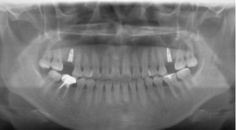 种植牙手术成功的因素有哪些 深圳健康资讯 南