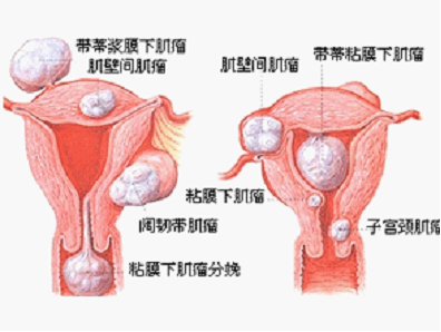 东莞南华妇科医院不开刀治疗子宫肌瘤 微创更